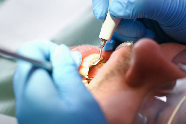 Best Dentist for Tooth Abscess  in South Bend, WA
