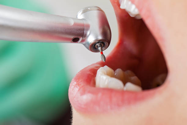 Best Chipped Tooth Repair Near Me  in South Bend, WA
